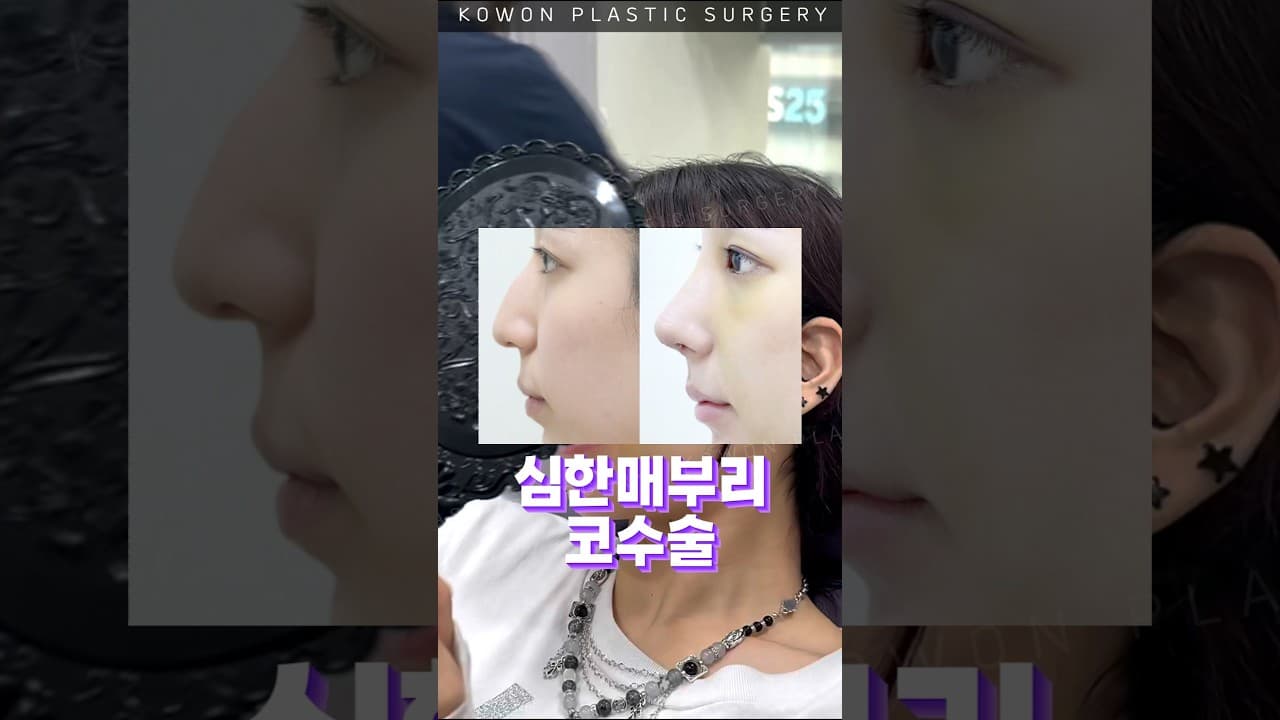 도드라진 매부리코, 자연스럽게 정리했더니?