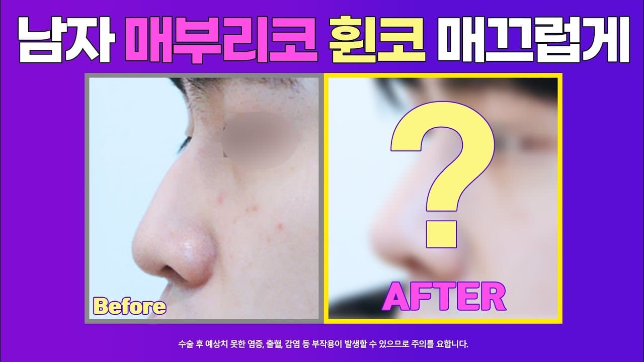 남자 매부리코 휜코 매끄럽게 교정