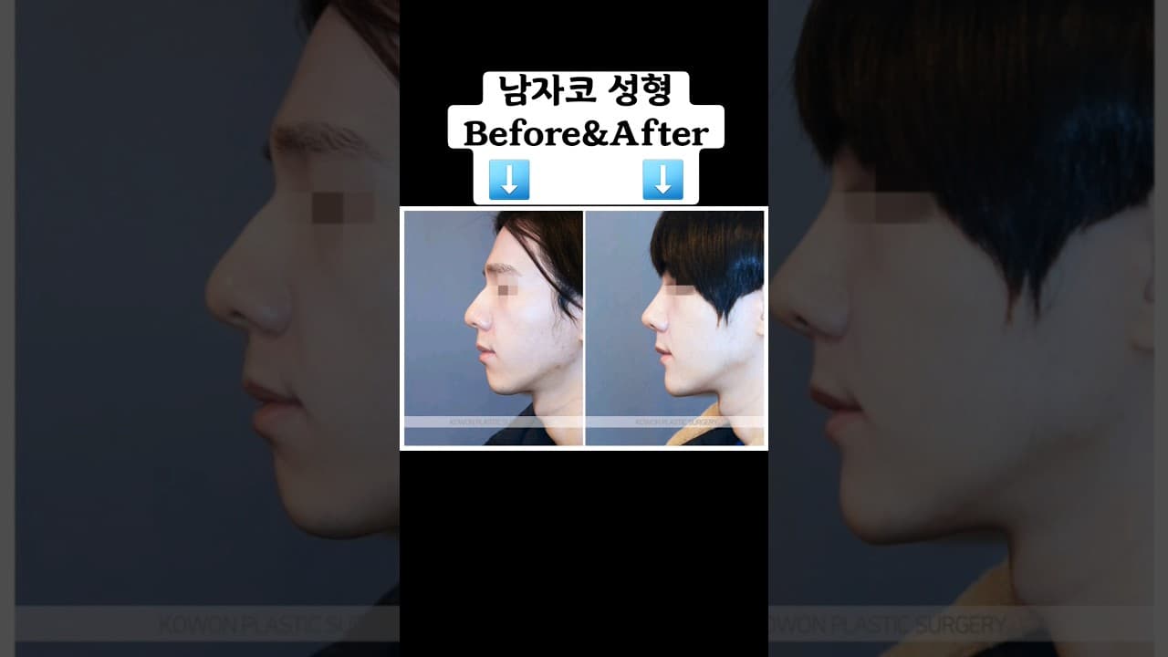 남자 코성형 Before&After (코원 | 매부리코, 복코, 휜코, 들창코 교정)