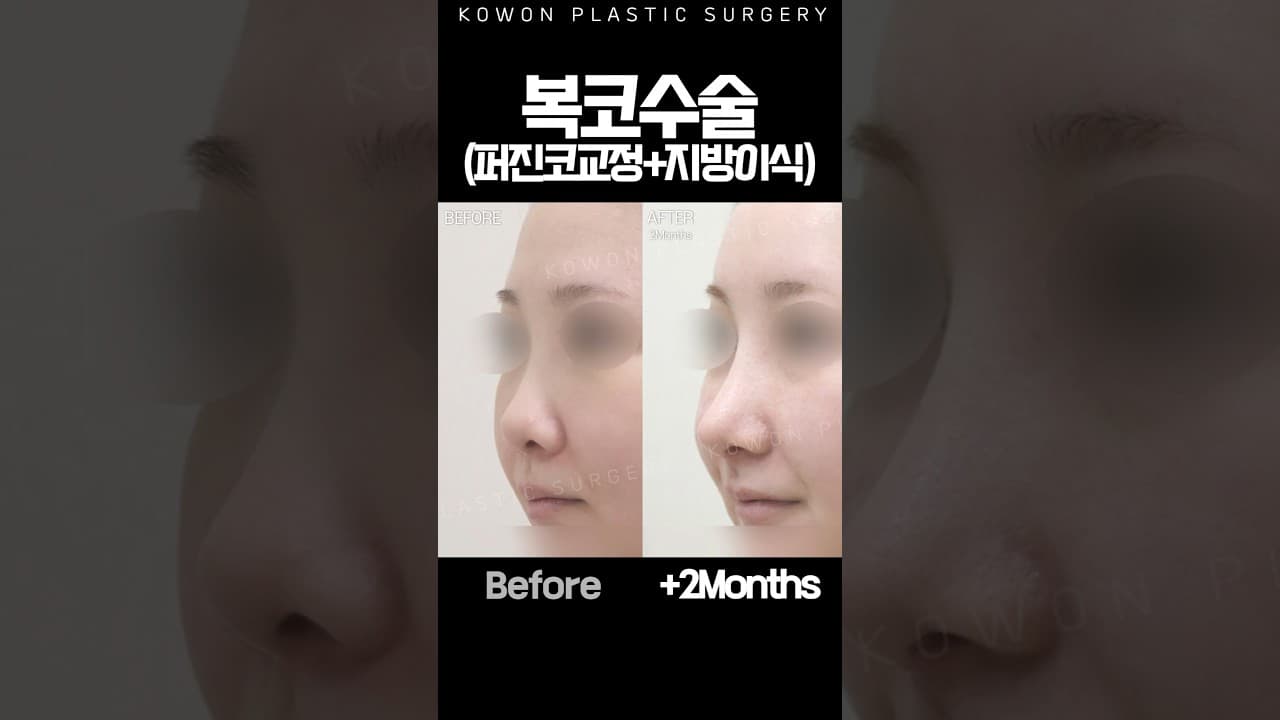 복코수술에 지방이식 추가했더니?