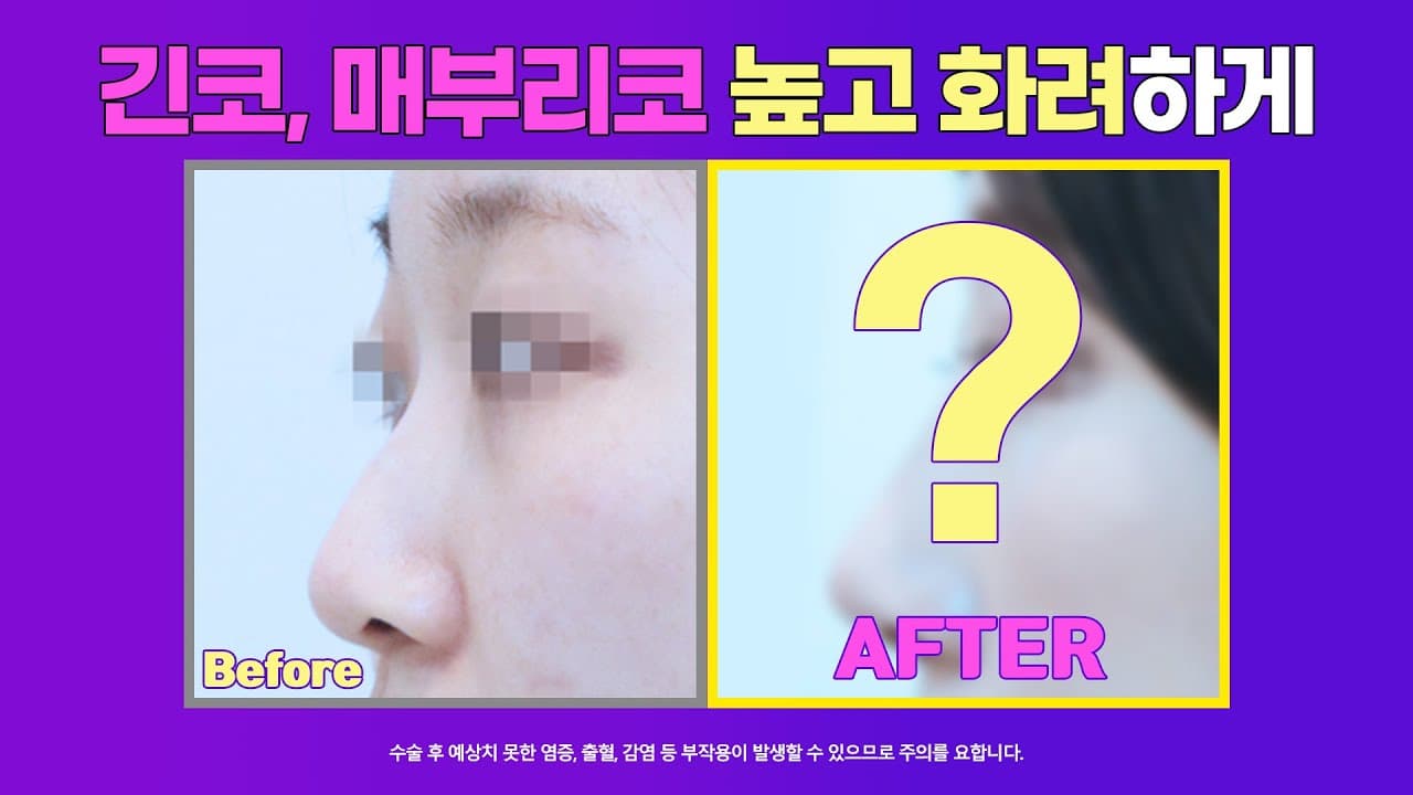 긴코 수술전후: 코끝내림근제거, 매부리코 제거 높고 화려한 코로 #nosejob #kowon #매부리코