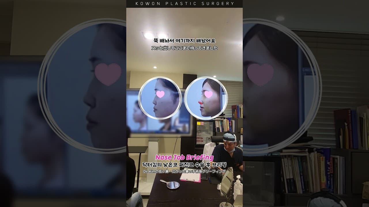 Part.3_낮은코 퍼진코 수술 후 브리핑코 (코수술했더니 입매가 예뻐졌다?) #nosejob #美容整形