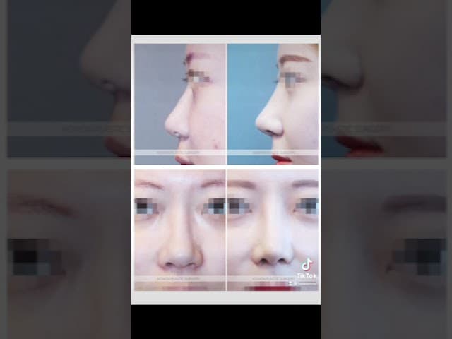 코원성형외과 코 성형 ★Before & After★