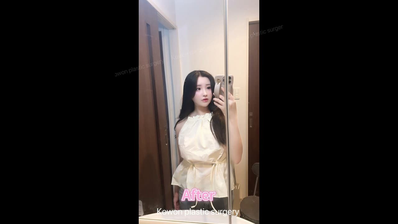 휘어버린 코ㅠㅠ 자연스럽게 코재수술 (코원 코끝+휜코교정)