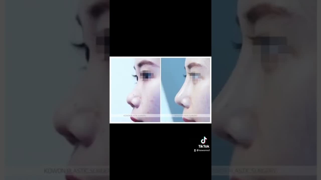 코원성형외과 코 성형 ★Before & After★