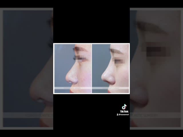 코원성형외과 코 성형 ★Before & After★_매부리코