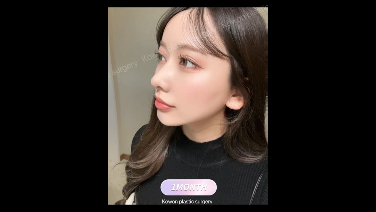 얄쌍한 코끝, 콧볼 교정 증례, 코원 예쁘고 자연스러운 개선