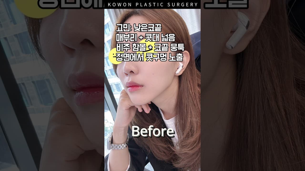 정면에서 보이던 콧구멍, 이렇게 달라졌습니다