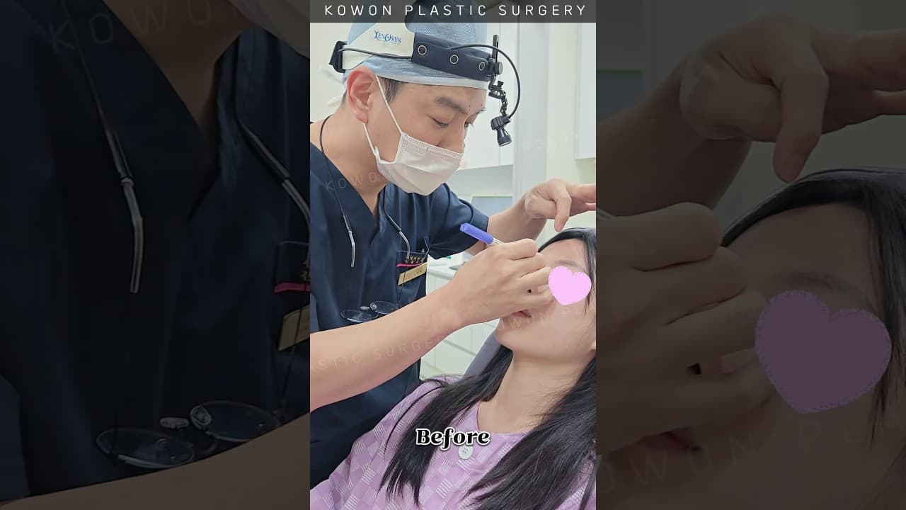코수술했는데, 입매가 달라졌다?