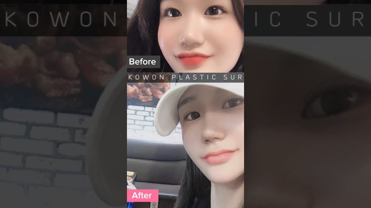복코교정 before and after(Bulbous Nose plastic surgery before and after)