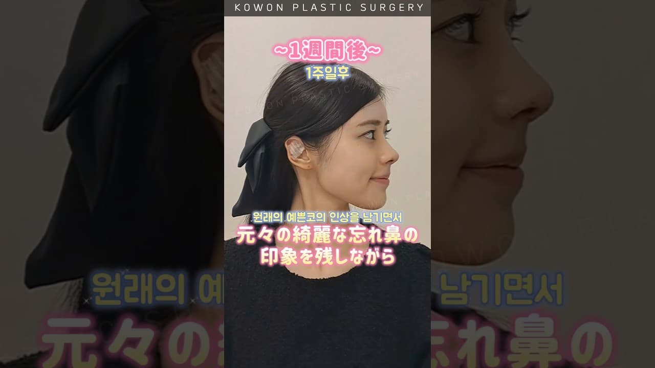 ✨ 코원 낮은코+매부리코 성형 리얼 후기 ✨