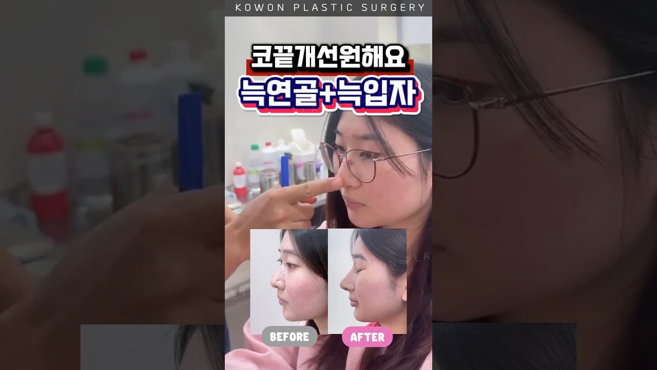 코끝 개선, 자연스럽게 (늑연골+늑입자)