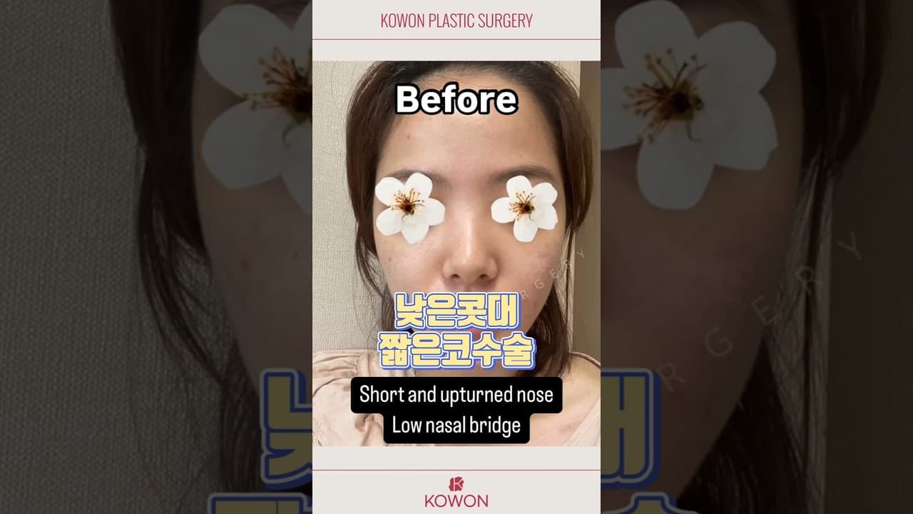 짧고 낮은코, 이렇게 바뀔줄이야