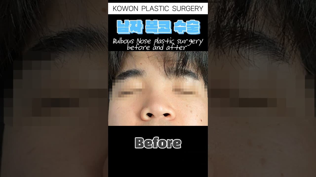 남자 복코 수술 전 후 (Bulbous Nose plastic surgery before and after)