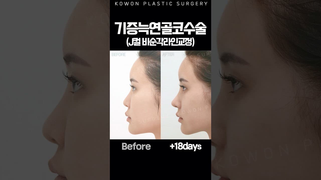 ✨ 기증늑연골 코성형 + J컬 비순각 교정 Before & After ✨