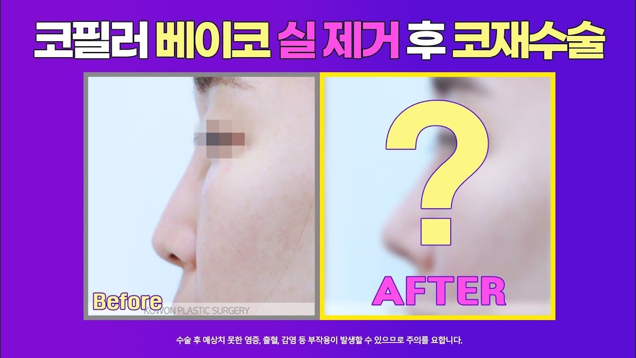 베이코제거, 미스코제거 후 코재수술 : 코 안의 이물질제거후 코수술을 하신 경우 #코원성형외과 #코재수술 #美容整形 #韓国整形