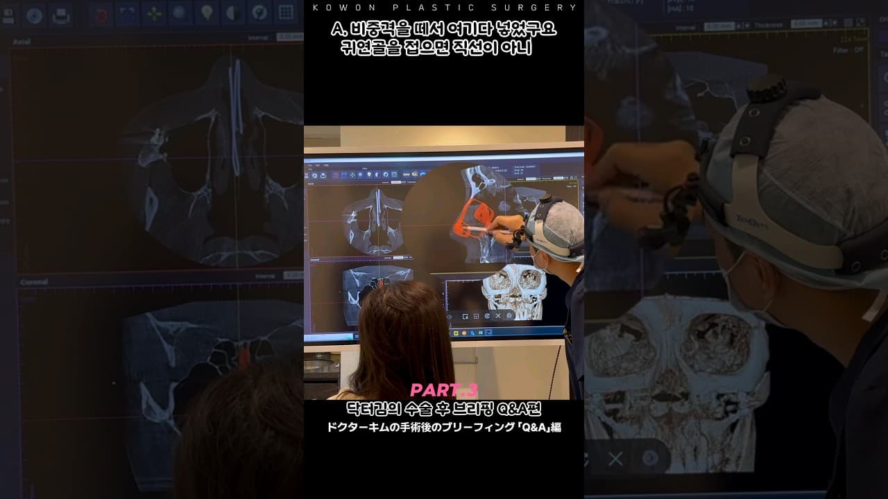 Part.3 코성형하면서 비중격교정 하면 코안 모양은 어떨까? 코원 CT경과 Q&A 브리핑 같이보기
