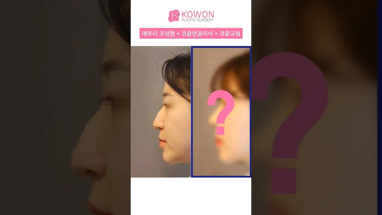 [KOWON]매부리코성형+코끝연골이식+코끝교정 직반코로 여성스럽게! (Before and After Hooked nose)