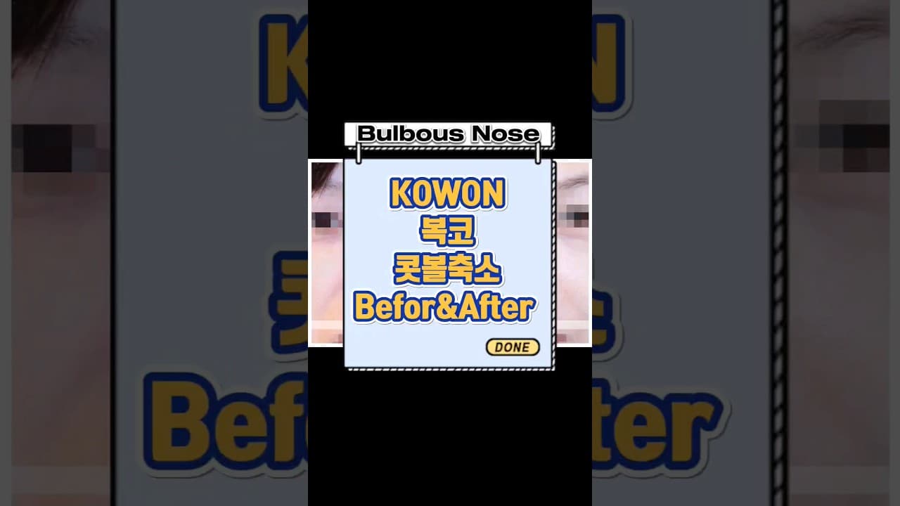 코원성형외과: 복코 콧볼축소 전 후 복코스트레스 해소Before and after Nose Job (Bulbous Nose) #nosejob #だんご鼻