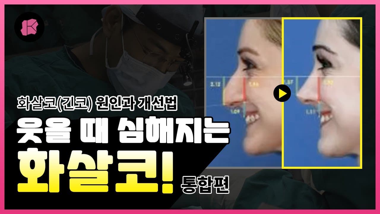 화살코, 긴코성형 재수술 안 하려면 필수시청! 👃 화살코 원인과 수술방법 ~통합편~