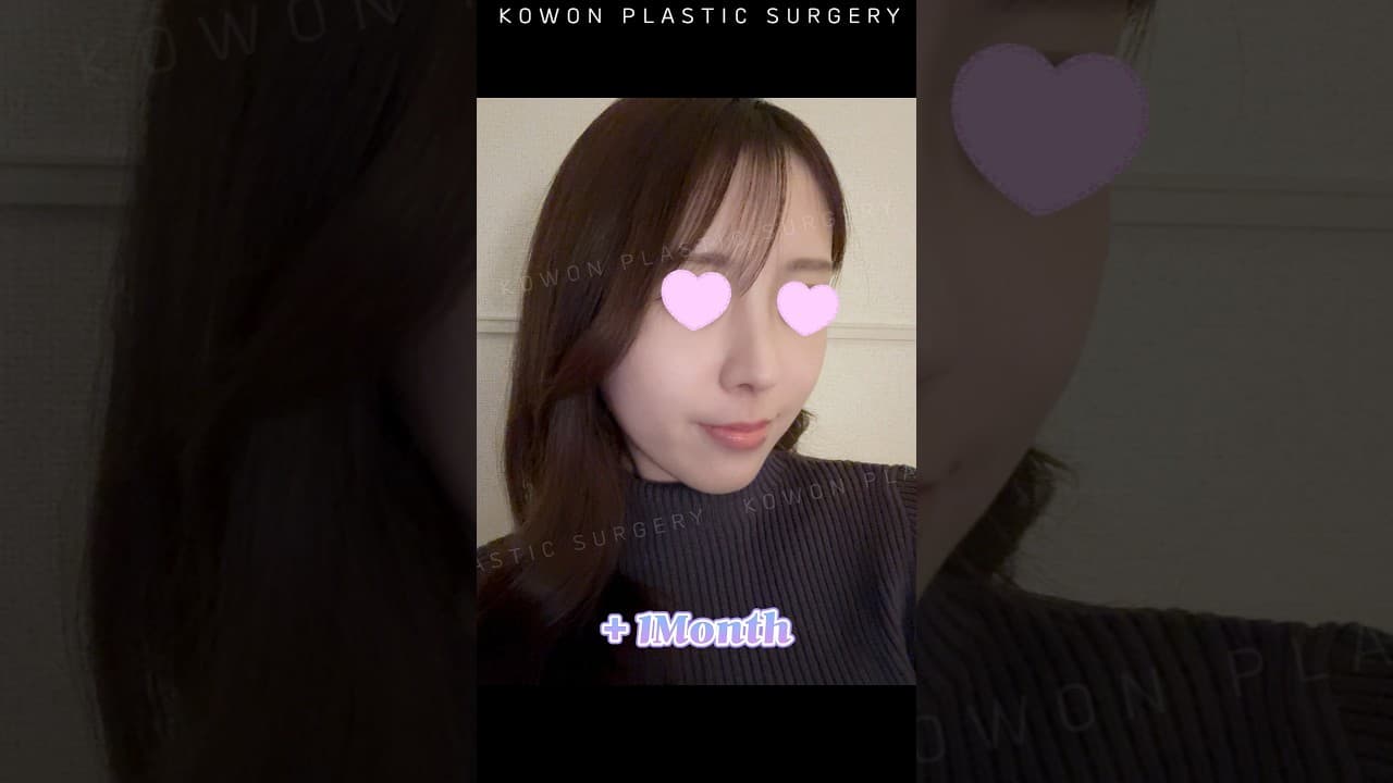 콧구멍 노출과 돌출되보이는 입매, 자연스럽게 개선한 후기✨