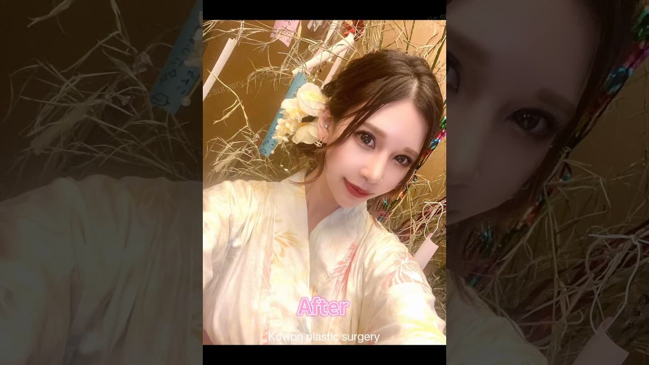 넓은 콧볼, 낮은 콧대 교정했더니