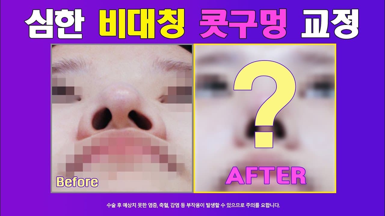 매부리코, 심한 비대칭 짝짝이 콧구멍 교정 전 후(Before and after correction of the hooked nose)