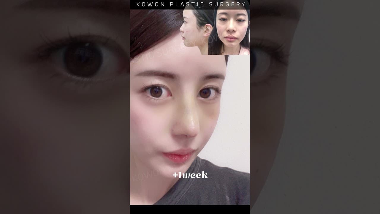 낮은코교정 | 낮코 퍼져보이는코, 눈과 눈사이 먼것도 고민