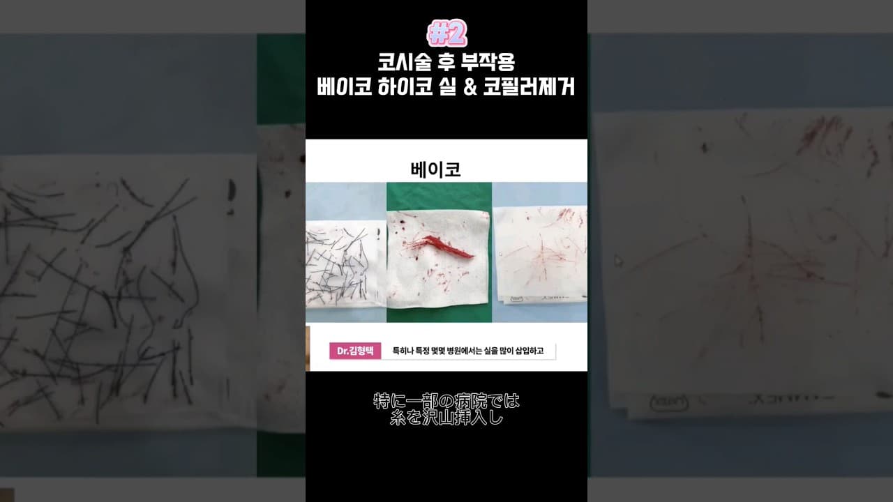 코시술 부작용베이코 하이코 실&코필러제거 2편鼻の手術後の副作用時、手術の形状維持材の除去 Part.2