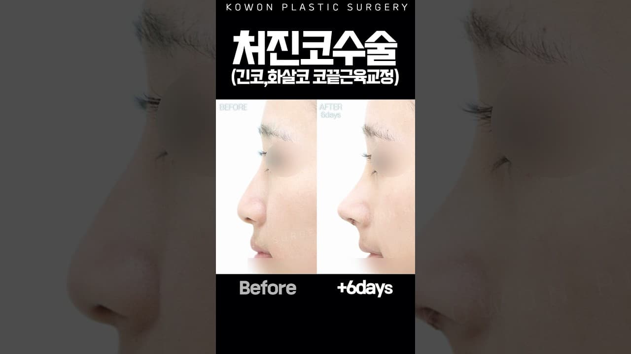 처진코 올리기만 하면 될까?