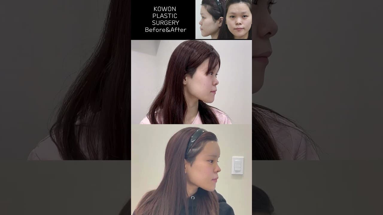 짧고 낮은 들창코 교정 Before & After