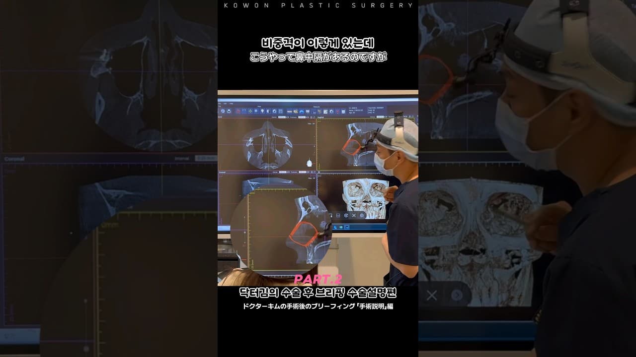 Part.2 코성형하면서 비중격교정 하면 코안 모양은 어떨까? 코원 CT경과 코수술 방법 설명 브리핑 같이보기