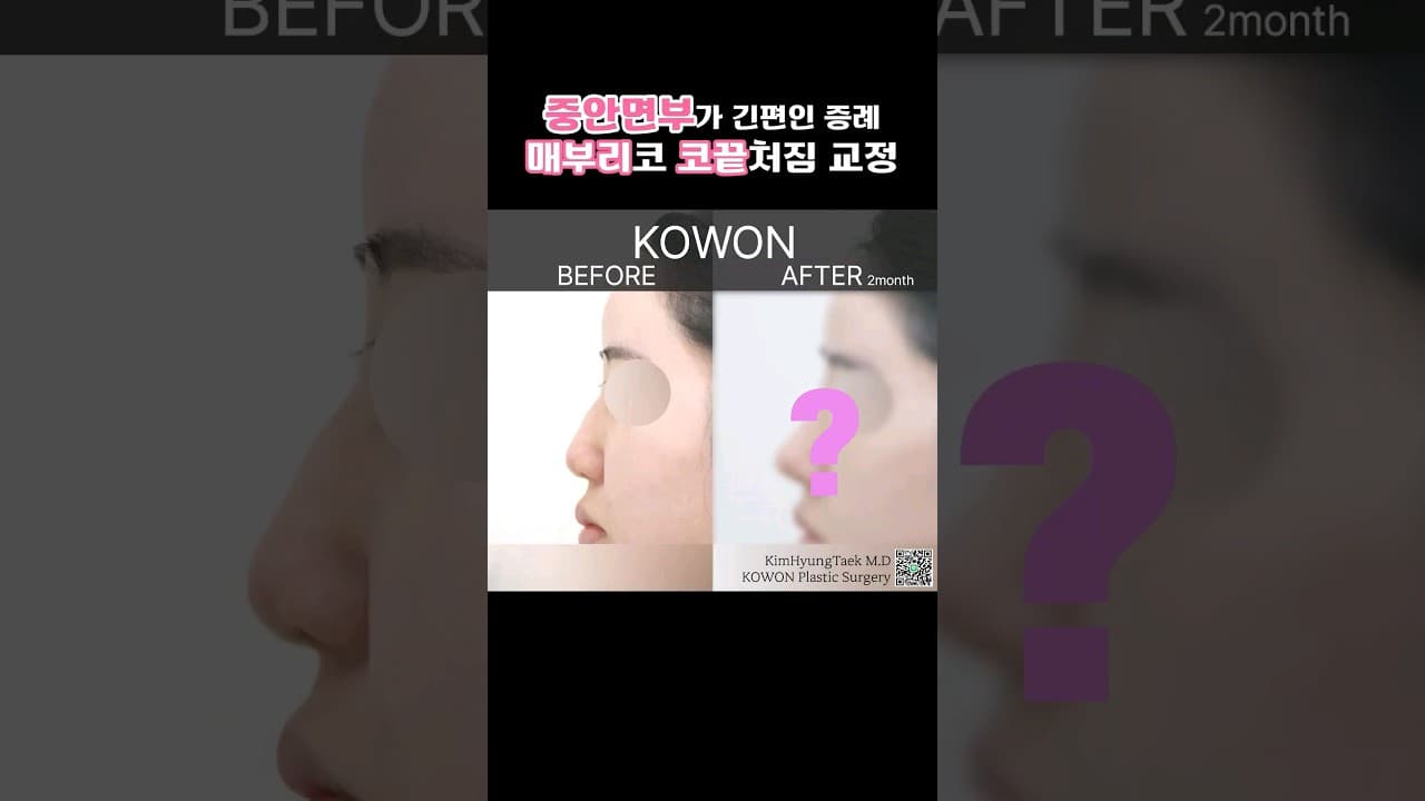 코끝이 눌리면서 퍼진코 고민 전체적으로 오똑하고 화려한코 되고싶어요
