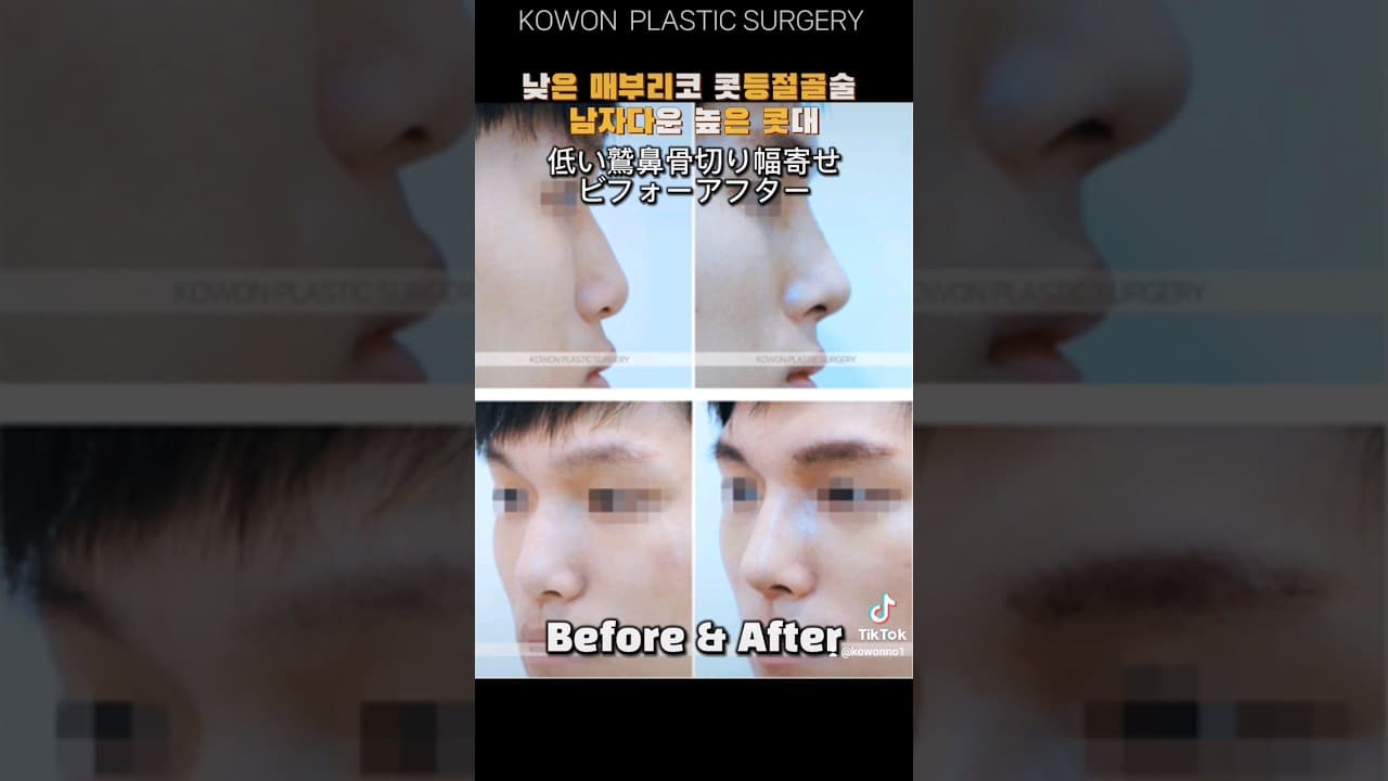 남자매부리코 전후사진 : 낮은 매부리코 콧등절골술 , 남자다운 높은 콧대 (Surgery of the hooked nose)
