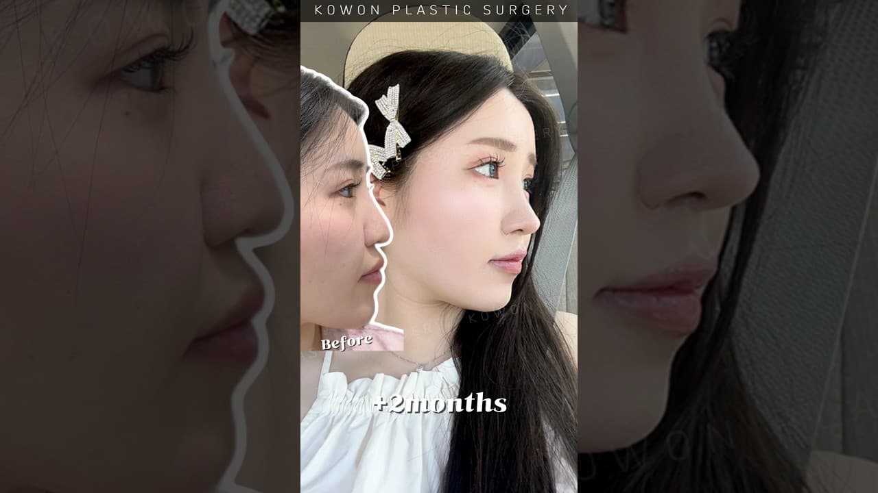 자려하게 코재수술 가능? (코수술하고 떨어지는 코끝) #코성형 #nosejob