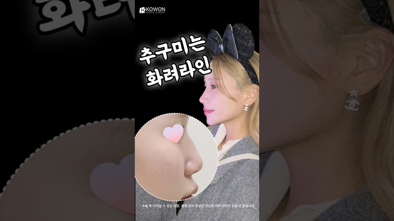 매부리코 교정으로 화려한 직반라인 완성! (화려한 코 성형 후기)