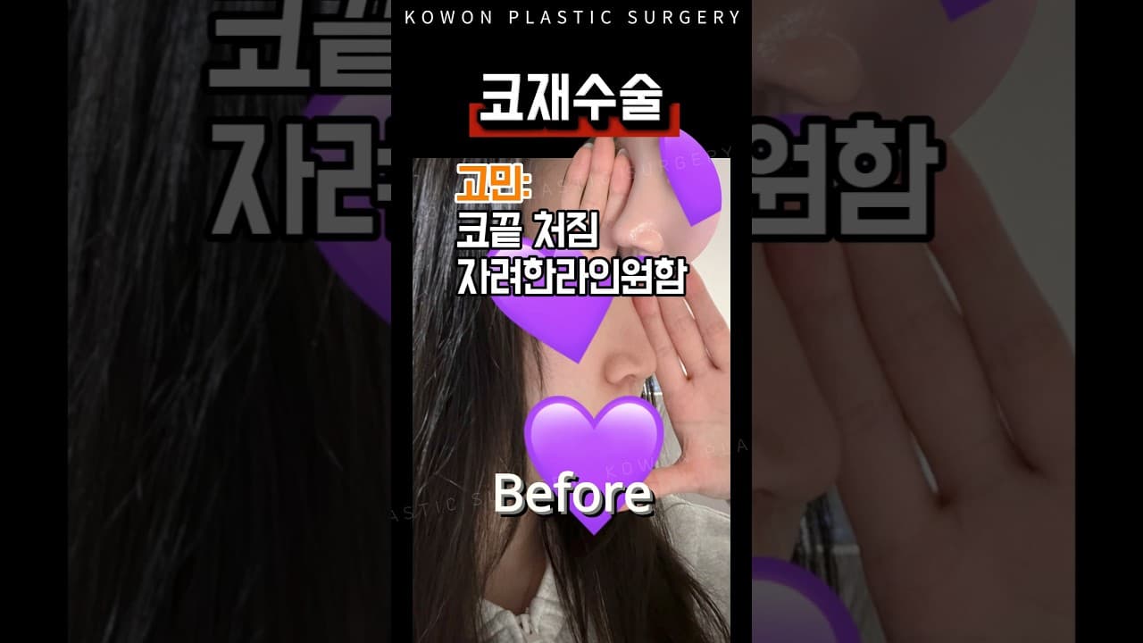 코재수술; 코끝 처짐 교정했더니 인상이 달라졌다고?