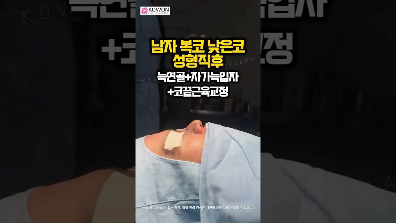 남자 복코 성형직후 | 낮은 복코와 콧구멍 비대칭 교정! 비중격만곡증 치료와 자가늑연골로 완성한 자려한 직선 라인 비포에프터