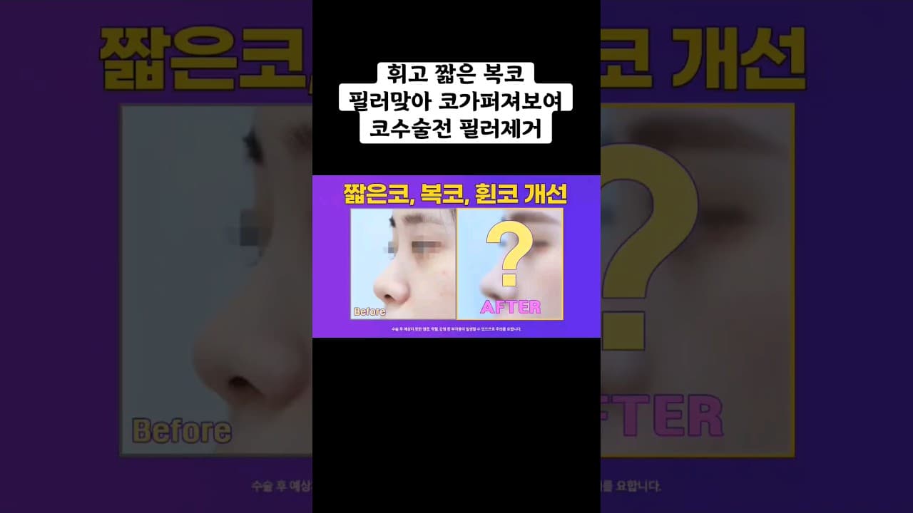 짧은코, 복코, 휜코느낌개선 비중격연장 2주차 수술 전 후 (feat. 필러녹이기)Bulbous Nose plastic surgery,remove nose filler