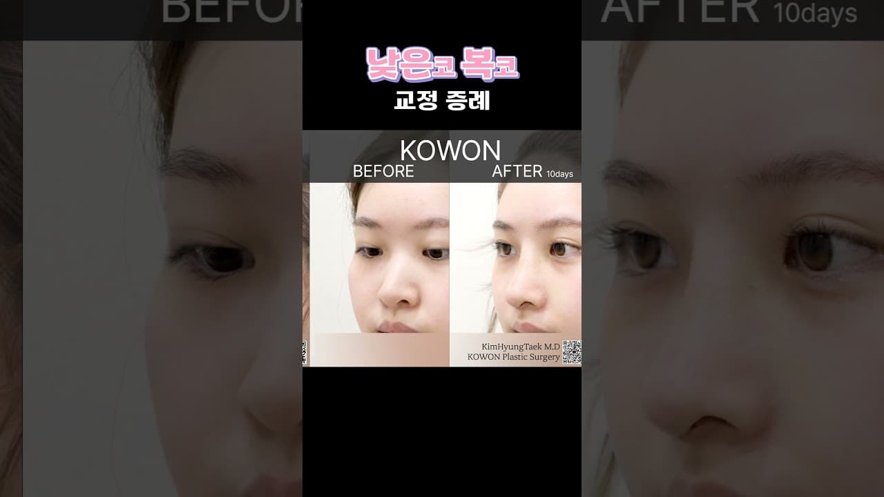 낮은코 복코 교정으로 예쁜데 더 예뻐짐