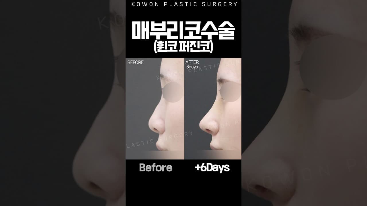 매부리코 + 복코 + 짧은코 개선 케이스 ✨