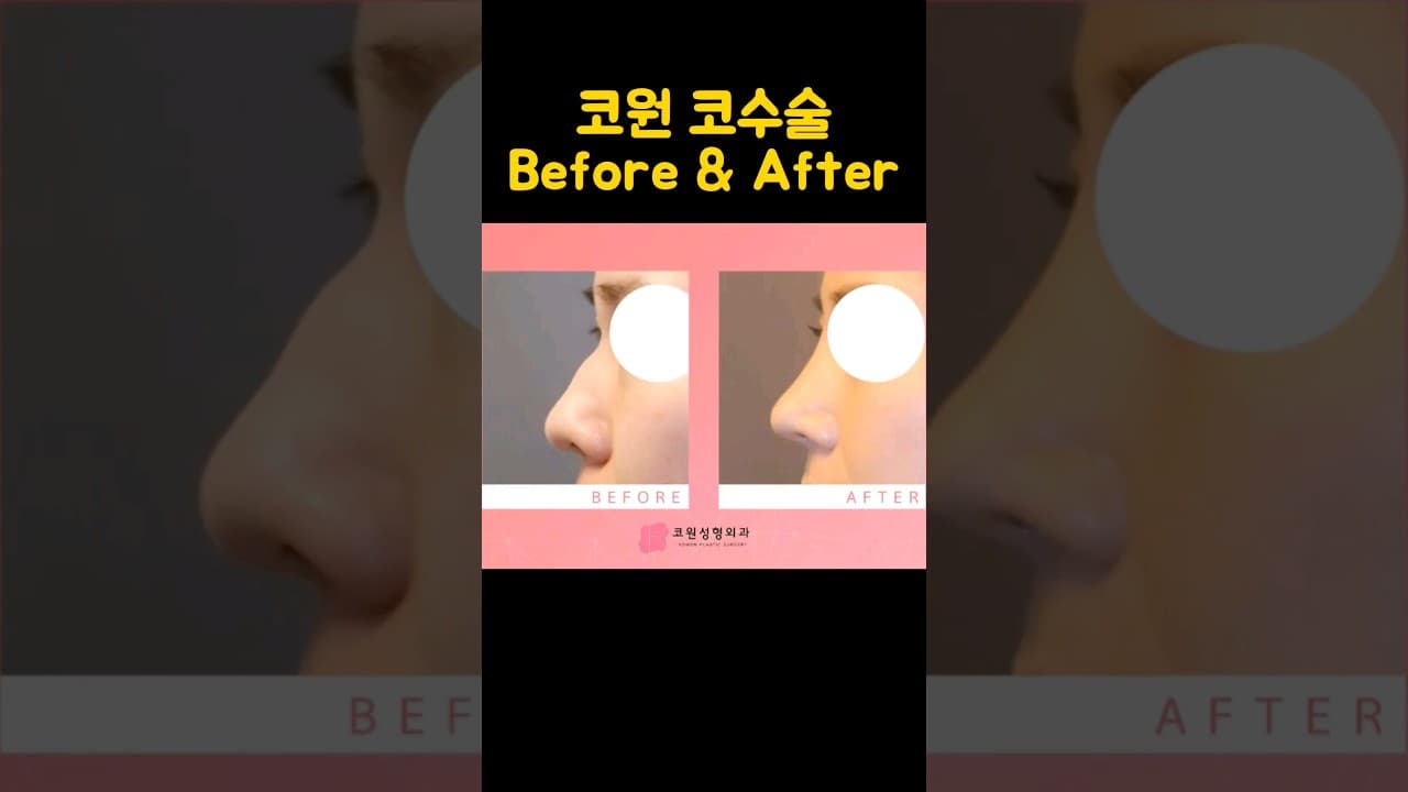 코원성형외과 코수술 전 후(매부리코, 복코, 들창코, 짝코)