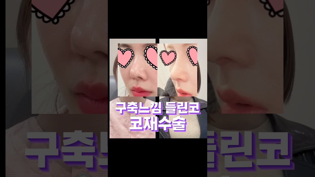 구축느낌 들려보이는코 재수술했더니?