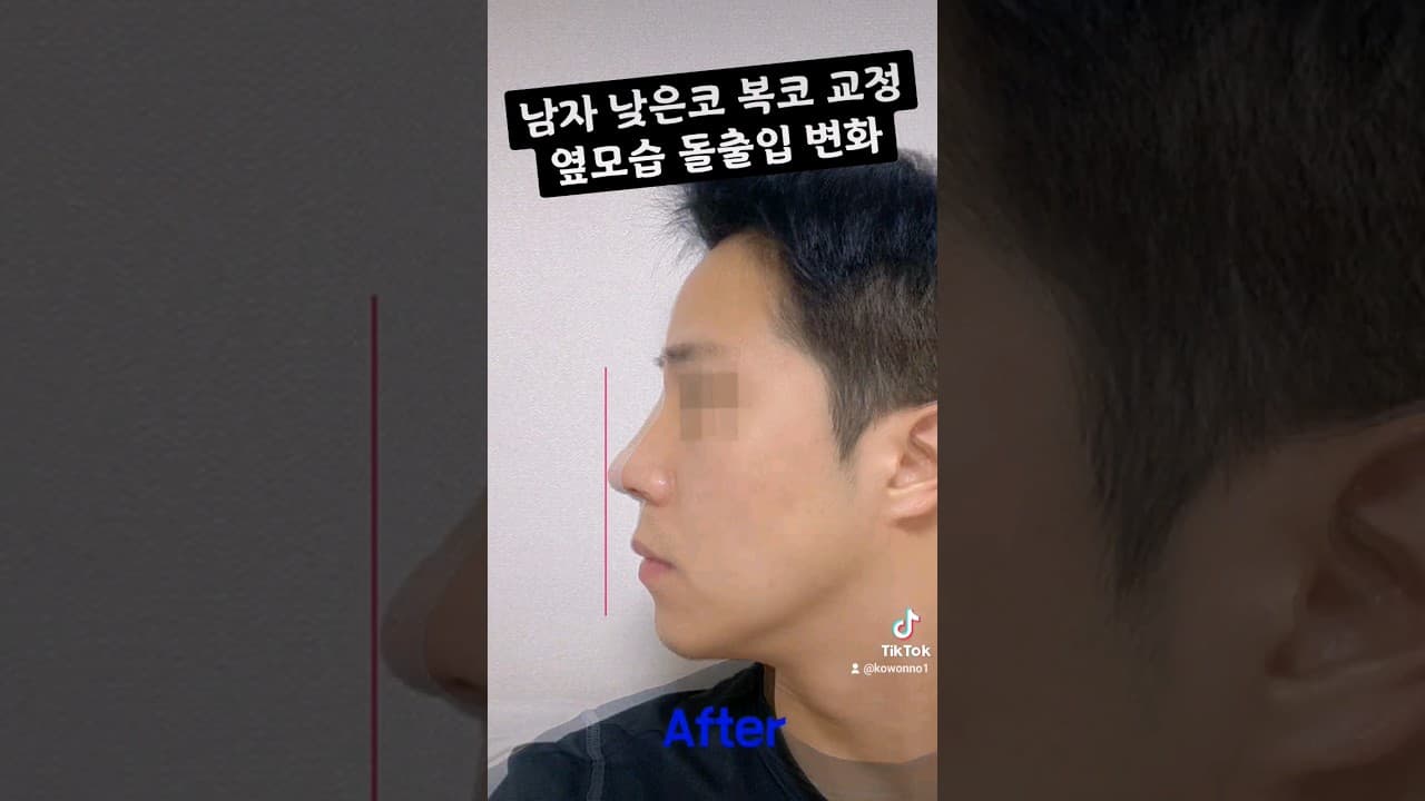 남자 낮은코 복코 교정 옆모습 돌출입 변화