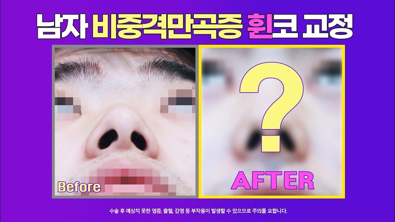 남자 휜코 교정 전후 | 비중격만곡증과 비염이 생기는 원인과 수술법