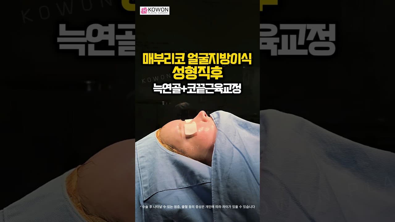 매부리코 휜코 성형직후, 지방이식으로 입체감 있게 개선된 비포에프터 👃✨