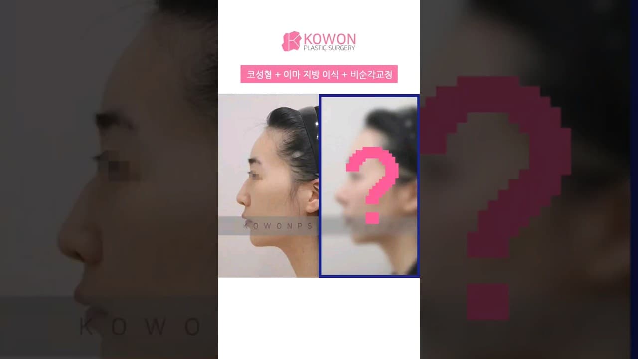 🌈 코원 인형옆라인3종 전 후 | 코 + 이마의 지방 이식 + 비순각교정수술 전후 변화에 주목