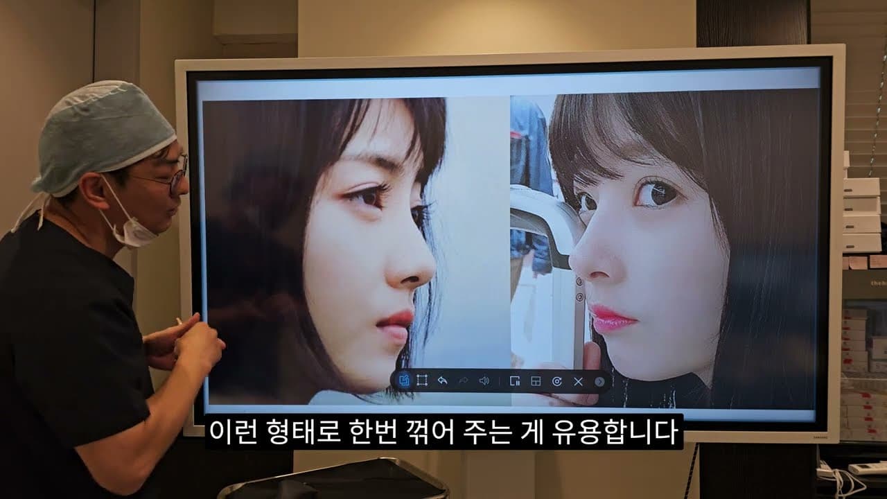 코성형성공디테일, ACR을 아십니까? 비주와 비순각라인 , 코모양과 입술모양의 관계