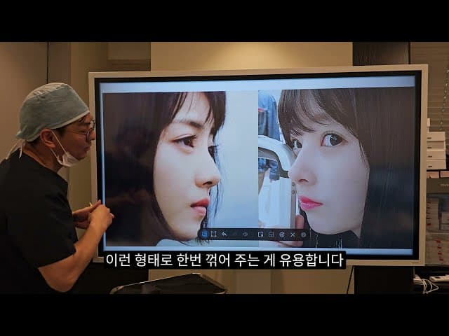 코성형성공디테일, ACR을 아십니까? 비주와 비순각라인 , 코모양과 입술모양의 관계