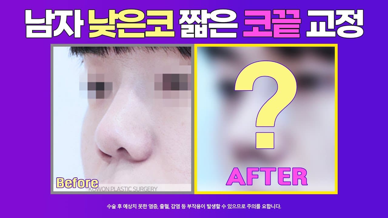 남자코성형 전후: 자연스러운 직선코 남자코수술 #코원성형외과